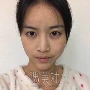 黄寺整形医院哪个医生修复双眼皮好?想去面诊下! width=
