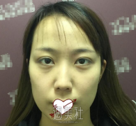 王涛隆鼻果怎么样：有案例分享嘛~ width=