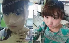 洛阳孔繁荣做双眼皮怎么样?真能出神入化的果? width=