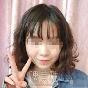长治市天成美容医院隆鼻案例分享，还行哈~ width=
