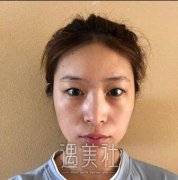 杨仁宝切双眼皮案例：大眼萌妹怎么来的~ width=