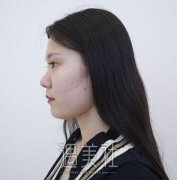 南京韩辰晏义兵隆鼻案例：鼻子决定五官高度~ width=