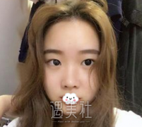 侯亚杰做双眼皮怎么样，全切双眼皮真实案例 width=