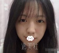 邱文苑双眼皮案例：一个月变身电眼美少女 width=