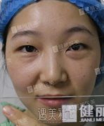 薛红宇去眼袋案例：眼睛终于有神啦！ width=