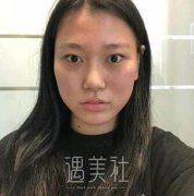 赵延勇双眼皮果图分享：恢复得灰常自然哦! width=