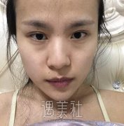 李圣利隆鼻案例：闺蜜们都来问我在哪里做的! width=