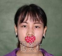 杨欣隆鼻果好不好：做了两个月的案例分享 width=