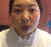 李发成面部吸脂怎么样?有近期案例力证一下吗? width=