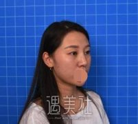 九院祝联双眼皮案例：大大的眼睛才属于我! width=
