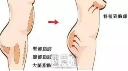 自体脂肪隆胸