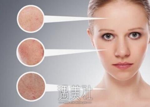 激光美容除皱