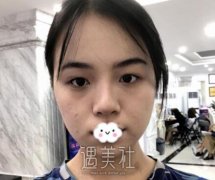 上海九院施耀明双眼皮案例：水汪汪的贼好看！ width=