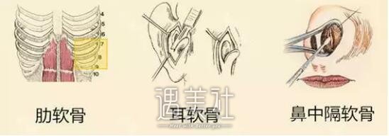 北京隆鼻一般多少钱，两万贵不贵?