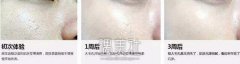 泉州果酸换肤价格会不会很贵，具体多少钱呢? width=