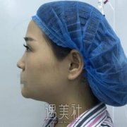 北京八大处杨欣隆鼻案例：五官和谐多了~ width=