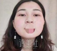 曹卫刚面部吸脂案例：没有嘟嘟肉就是好看啊! width=