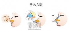 蒜头鼻整形前后对比，蒜头鼻整形的果好吗？ width=