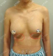 广州荔湾人民医院齐云香奥美定取出案例分享，恢复得不错~ width=