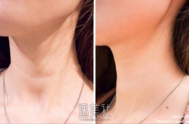 颈部皱纹怎么消除，什么方法比较好用?