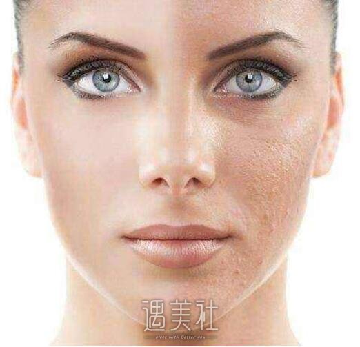 果酸换肤手术果能保持多久，能维持几年我就开心了~