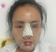 北京巫文云隆鼻案例：巫医生的手法果然娴熟! width=