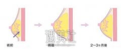 上海做自体脂肪丰胸的价格贵不贵，听说上海很贵啊? width=