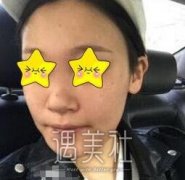 九院袁捷隆鼻案例：袁医生技术真的很不错哦！ width=