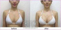 郑州自体脂肪隆胸价格是多少，为什么会这么贵? width=
