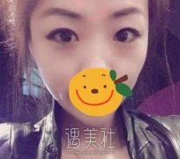 华西李正勇双眼皮案例：就是我想要的果哦！ width=