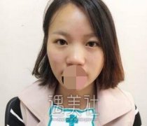 华西医院整形科卿勇鼻整形案例分享，还有恢复图片~ width=