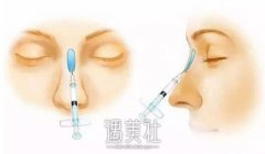 烟台注射玻尿酸隆鼻大概要多少钱 ，影响价格的因素有哪些? width=