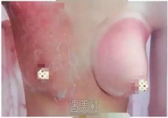 碧波庭丰胸案例：铲除了多年的“飞机场”~ width=