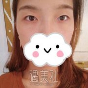 杨明勇双眼皮案例图片：大眼睛就是更上相啊～ width=