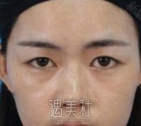 杨明勇双眼皮风格是怎样的？有真实案例吗？ width=