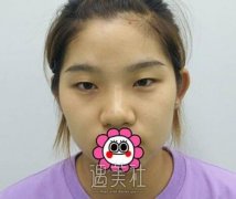 八大处陈文双眼皮案例:三个月后我打开了新世界的大门 width=