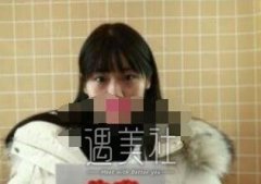 大连秦宏智双眼皮案例 亲身经历者来谈谈我的想法 width=
