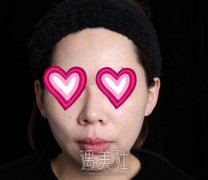 北京八大处杨欣隆鼻案例:颜值不够 鼻子来凑 width=