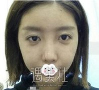 杨欣隆鼻案例：五官的立体感马上就有了~ width=