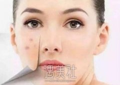 吉林祛痘印多少钱，做三次价格贵不贵？ width=
