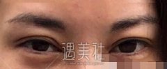 吴坤南双眼皮修复案例：同款美眼速来get width=
