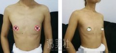 李朕 自体脂肪丰胸案例  打造触感柔软动态美胸 width=
