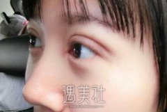 李东双眼皮案例：好看的人运气不会太差 width=
