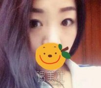 杨杰双眼皮案例：恢复记录+心得体会 width=