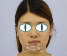 徐鹏隆鼻案例：气质上升了一个level width=