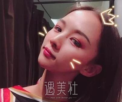 韦敏,隆鼻
