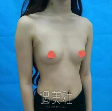 李德廷,丰胸