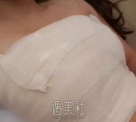 李德廷,丰胸