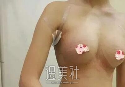李德廷,丰胸