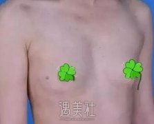 整形医生石蕾做丰胸案例  闺蜜说她酸了 width=
